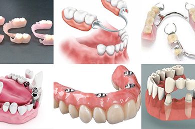 Implante-dental