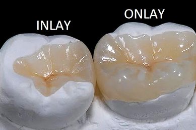 Implante-dental